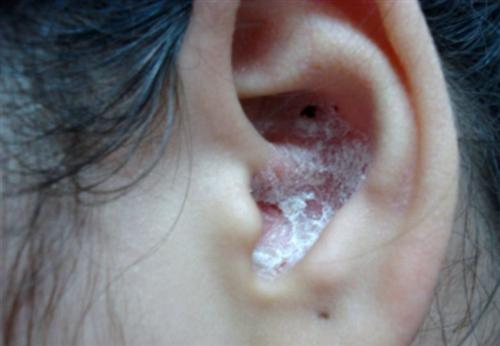 外耳湿疹