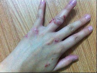 手湿疹