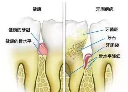 牙周萎缩