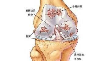 复发性风湿病