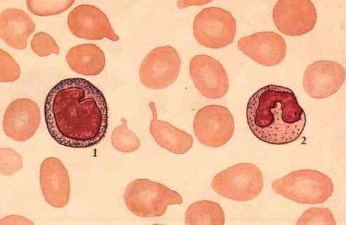 红细胞生成性卟啉病