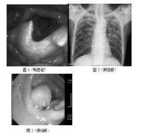 结核性溃疡