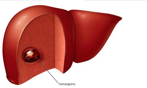 肝肿瘤