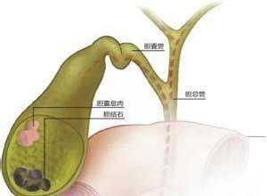胆囊肿瘤