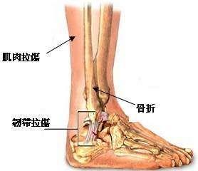 踝部骨折