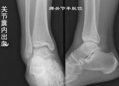 踝部骨折