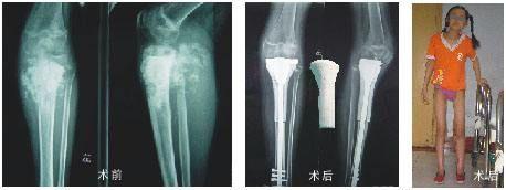 骨纤维肉瘤