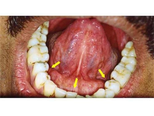 Oral Cancer On Floor Of Mouth Hot Sex Picture