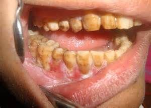 口腔黏膜白斑