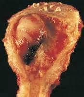 子宫肉瘤