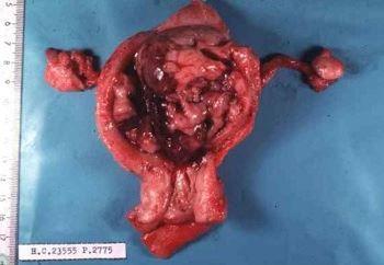 子宫肉瘤