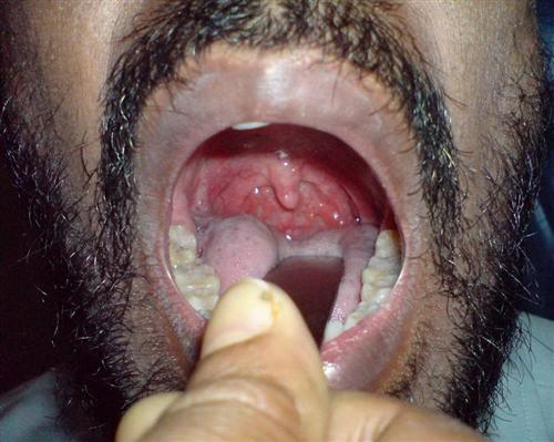 慢性鼻咽炎