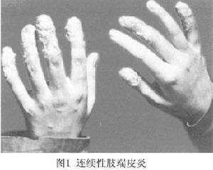 放射性皮炎