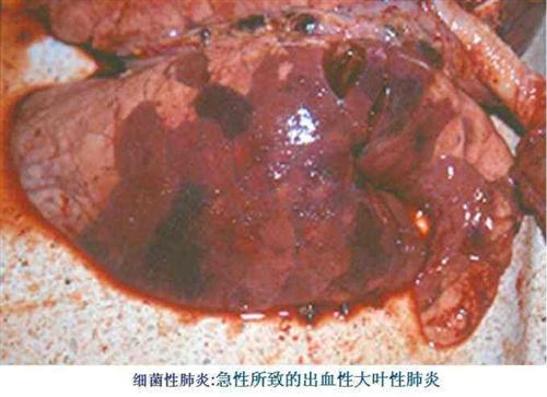 细菌性肺炎
