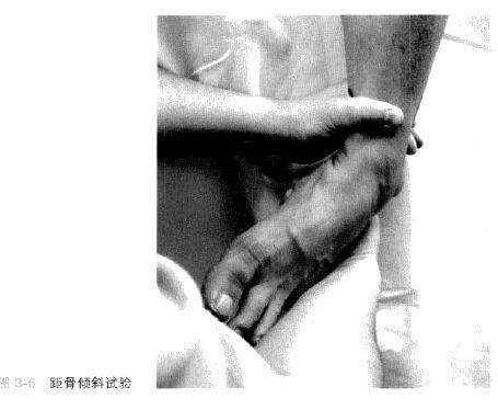 踝部骨折