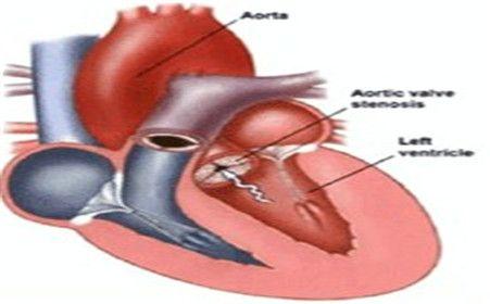 心室肌致密化不全