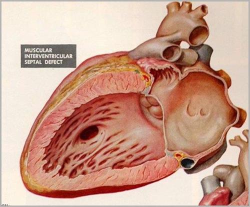 心室肌致密化不全