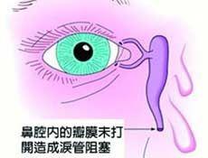 急性泪囊炎