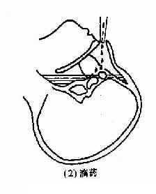 慢性蝶窦炎
