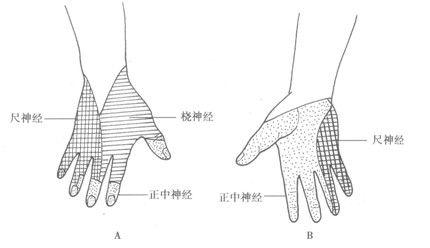 桡神经麻痹