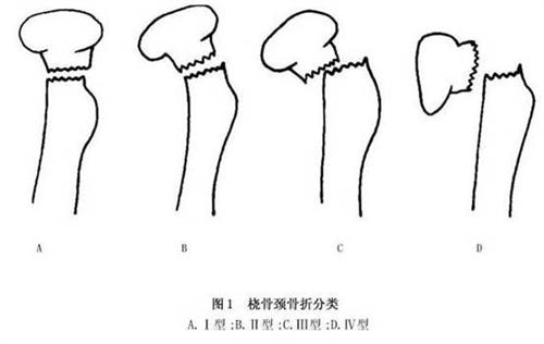 桡骨小头骨骺分离