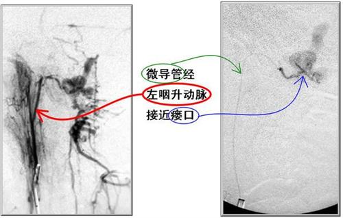 硬脑膜动静脉瘘