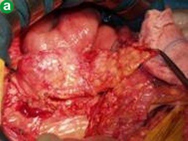 胰腺肿瘤
