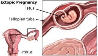 输卵管妊娠