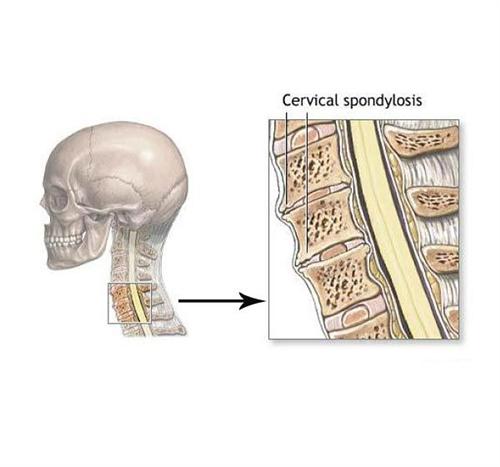 颈型颈椎病