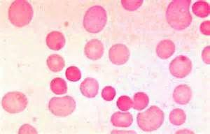 小细胞低色素性贫血