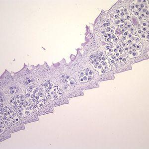 短膜壳绦虫病