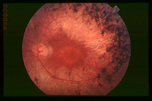 视网膜色素变性