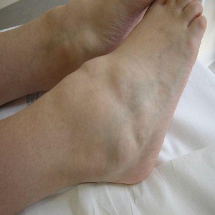 慢性骨髓炎