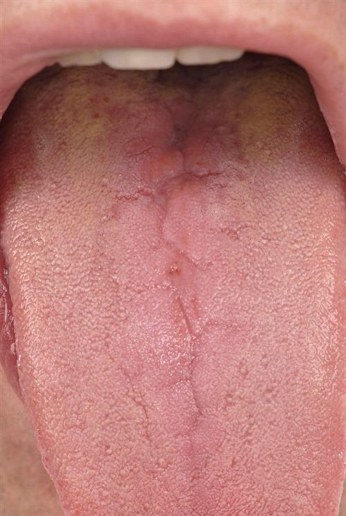 舌炎