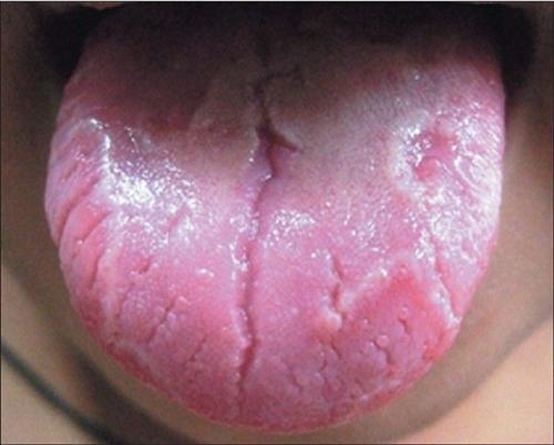 舌炎