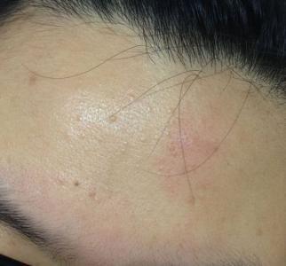 鼻部穿通性毛囊炎