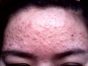 鼻部穿通性毛囊炎