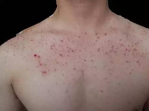 鼻部穿通性毛囊炎