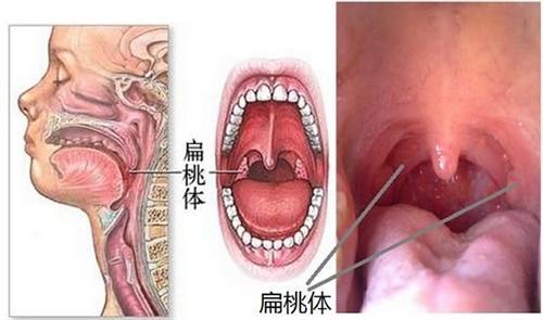 扁桃体炎