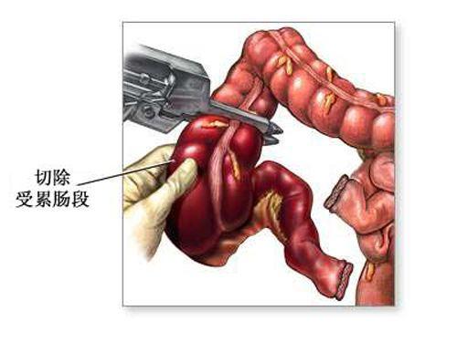 结肠直肠损伤