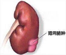 肾周脓肿
