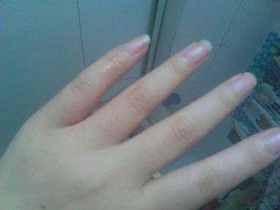 湿毒疮