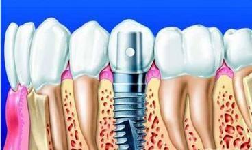 牙齿种植