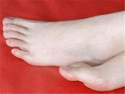 水疱型脚气