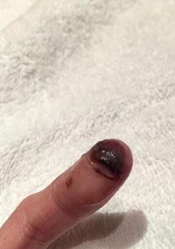 瘀证