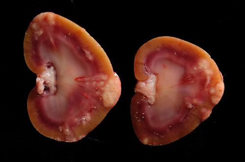 结缔组织性肠炎