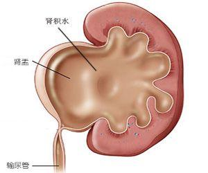 肾盂癌