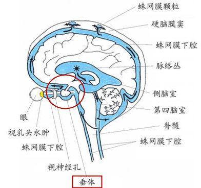 脑脊液漏