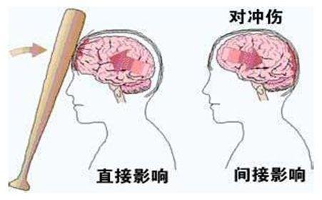 脑脊液漏