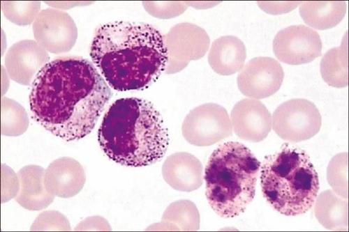 慢性髓细胞白血病